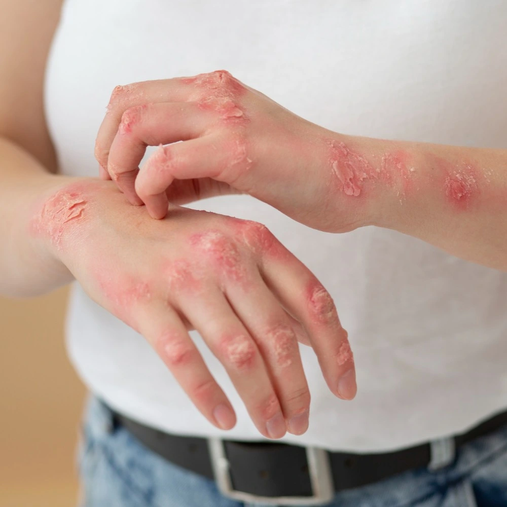 Can Leaky Gut Cause Skin Issues